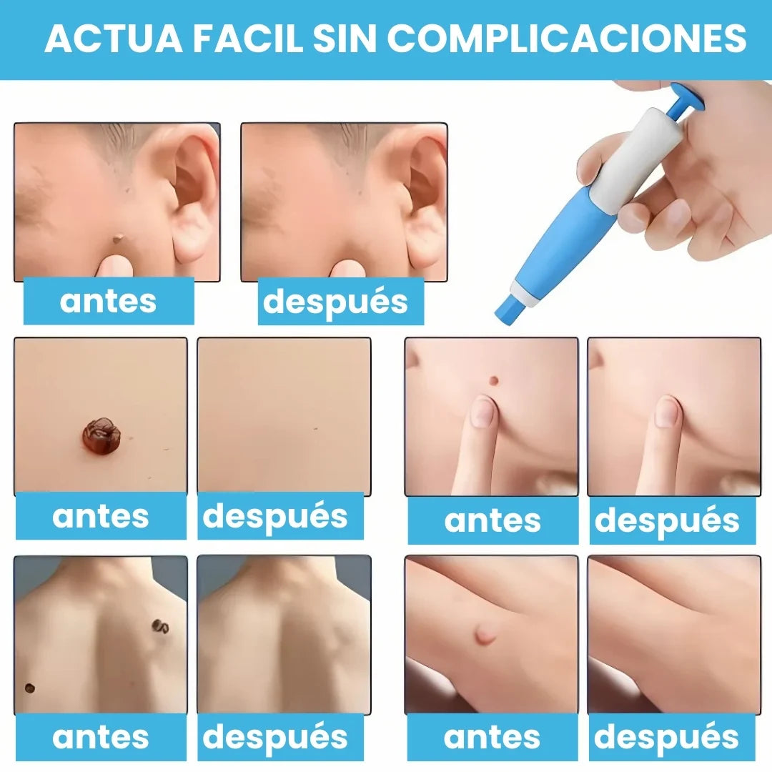 DERMOFIX® KIT CLÍNICO PARA REMOVER VERRUGAS