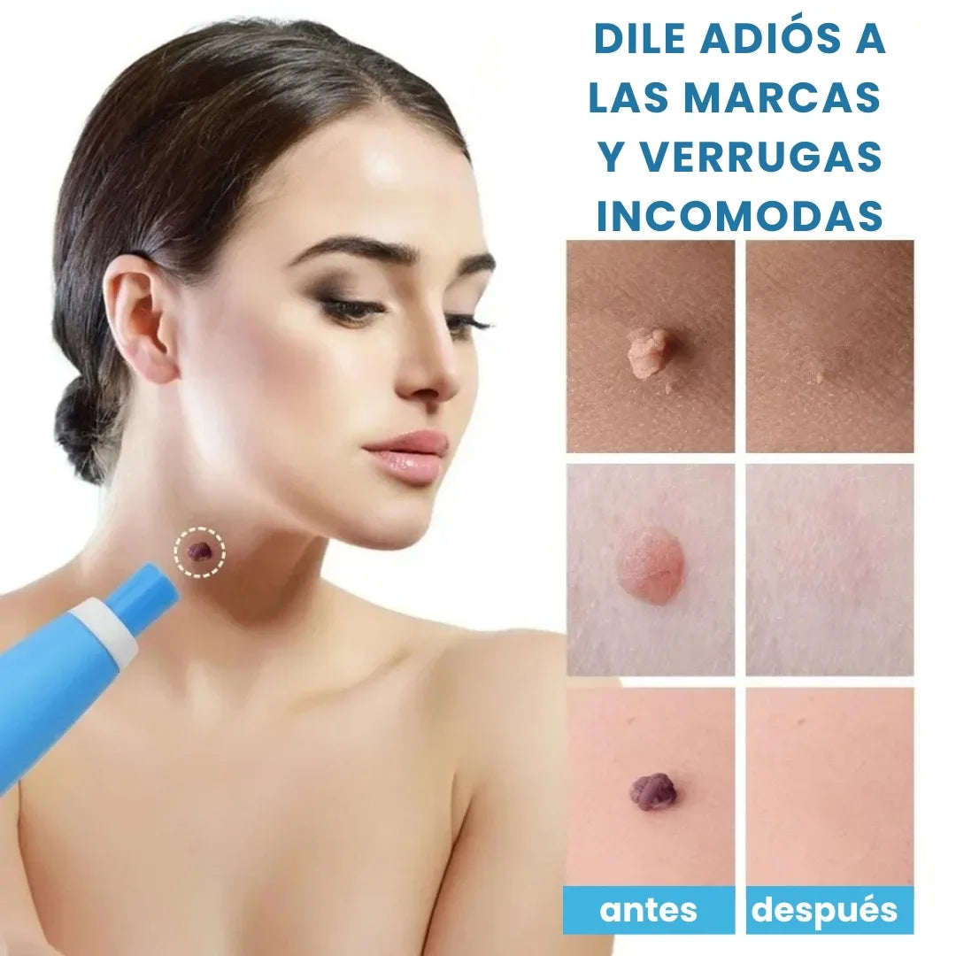 DERMOFIX® KIT CLÍNICO PARA REMOVER VERRUGAS