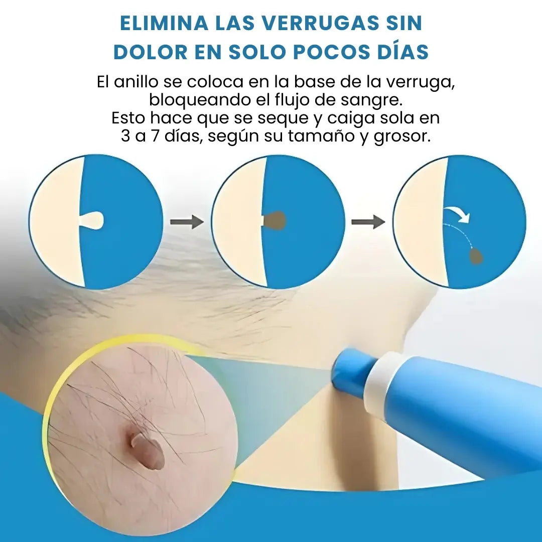 DERMOFIX® KIT CLÍNICO PARA REMOVER VERRUGAS